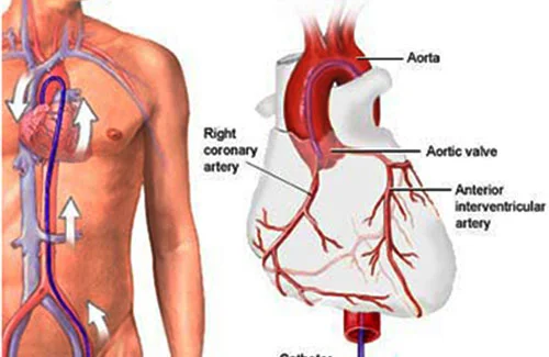 angiography-doctor-in-delhi