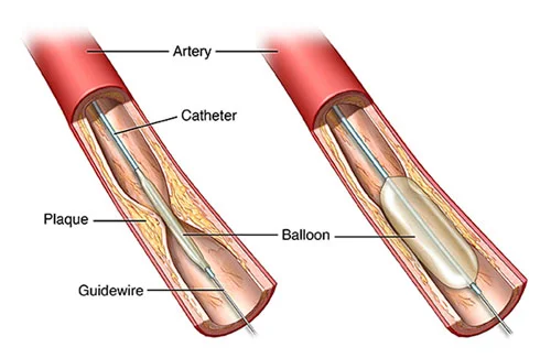 angioplasty-doctor-in-delhi