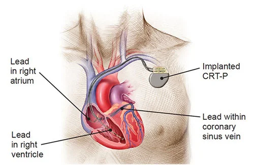 device-implantation-in-delhi