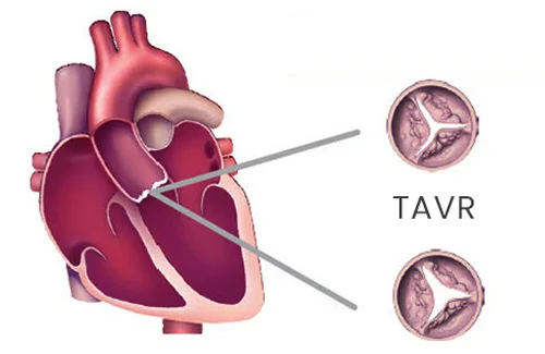 tavr-in-delhi